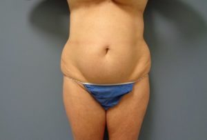 Tummy Tuck Before and After Pictures Nashville, TN