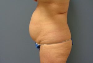 Tummy Tuck Before and After Pictures Nashville, TN