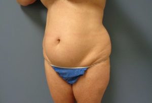 Tummy Tuck Before and After Pictures Nashville, TN