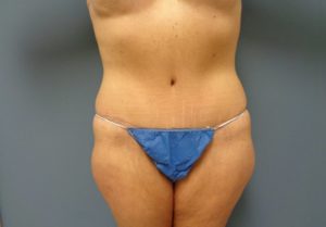 Tummy Tuck Before and After Pictures Nashville, TN