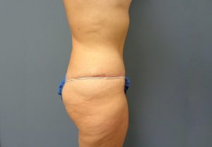 Tummy Tuck Before and After Pictures Nashville, TN