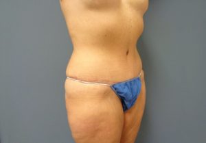 Tummy Tuck Before and After Pictures Nashville, TN