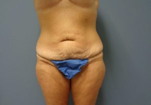 Tummy Tuck Before and After Pictures Nashville, TN