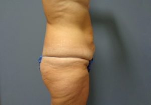 Tummy Tuck Before and After Pictures Nashville, TN