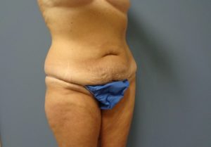 Tummy Tuck Before and After Pictures Nashville, TN