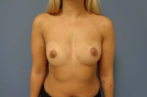 Breast Augmentation Before and After Pictures Nashville, TN