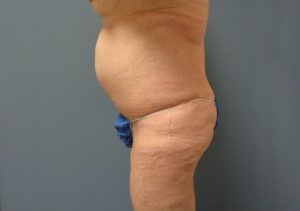 Tummy Tuck Before and After Pictures Nashville, TN