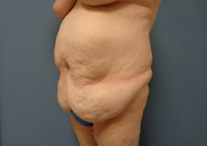 Tummy Tuck Before and After Pictures Nashville, TN
