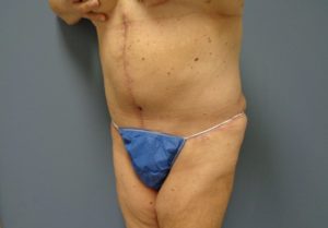 Tummy Tuck Before and After Pictures Nashville, TN