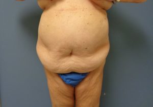 Tummy Tuck Before and After Pictures Nashville, TN