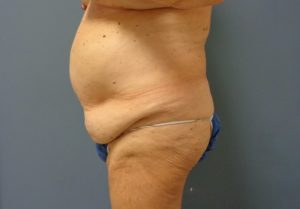 Tummy Tuck Before and After Pictures Nashville, TN