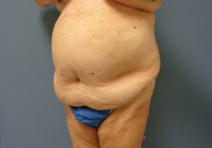 Tummy Tuck Before and After Pictures Nashville, TN