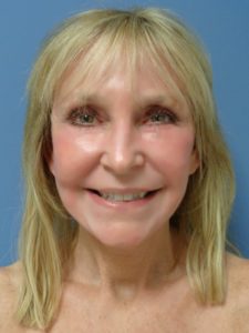 Facelift Before and After Pictures Nashville, TN