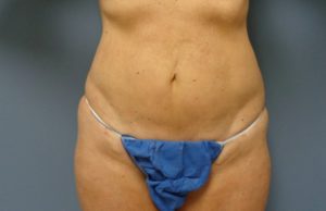 Liposuction Before and After Pictures Nashville, TN