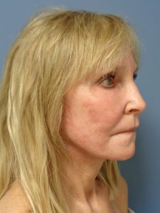 Facelift Before and After Pictures Nashville, TN