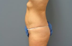 Liposuction Before and After Pictures Nashville, TN