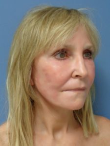 Facelift Before and After Pictures Nashville, TN