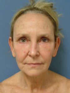 Facelift Before and After Pictures Nashville, TN