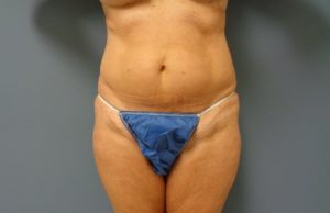 Liposuction Before and After Pictures Nashville, TN