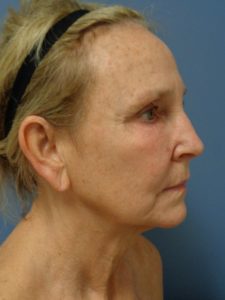 Facelift Before and After Pictures Nashville, TN