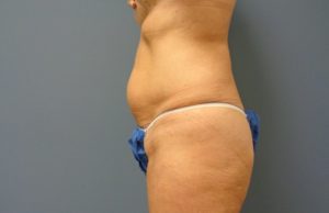 Liposuction Before and After Pictures Nashville, TN