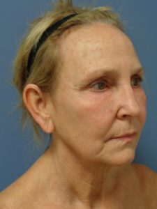 Facelift Before and After Pictures Nashville, TN