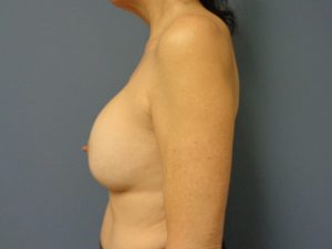 Implant Exchange/Removal Before and After Pictures Nashville, TN