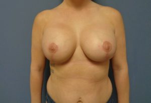 Breast Augmentation with Lift Before and After Pictures Nashville, TN