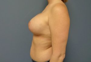 Breast Augmentation with Lift Before and After Pictures Nashville, TN