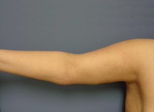 Arm Lift Before and After Pictures Nashville, TN