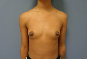 Breast Augmentation Before & After Pictures in Nashville, TN