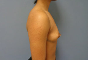 Breast Augmentation Before & After Pictures in Nashville, TN