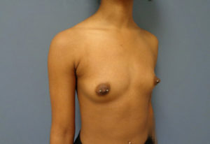 Breast Augmentation Before & After Pictures in Nashville, TN