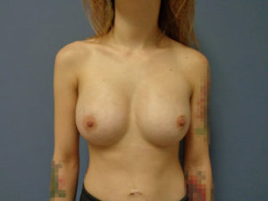 Breast Augmentation Before and After Pictures Nashville, TN