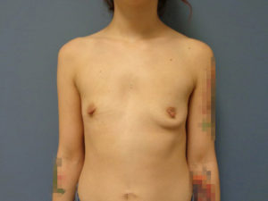 Breast Augmentation Before and After Pictures Nashville, TN