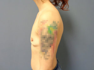 Breast Augmentation Before and After Pictures Nashville, TN