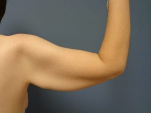 Arm Lift Before and After Pictures Nashville, TN