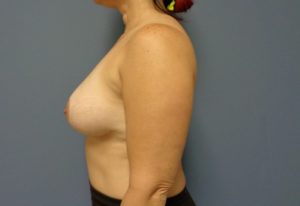 Implant Based Reconstruction Before and After Pictures Nashville, TN