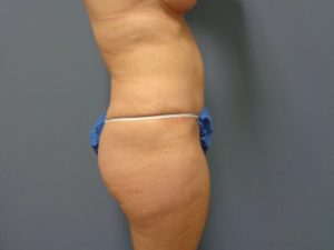 Tummy Tuck Before and After Pictures Nashville, TN