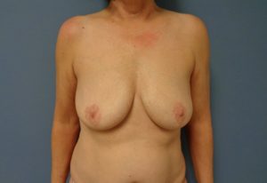 Implant Exchange/Removal Before and After Pictures Nashville, TN