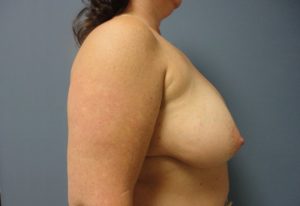 Implant Based Reconstruction Before and After Pictures Nashville, TN