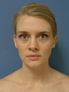 Otoplasty Before and After Pictures Nashville, TN