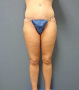 Thigh Lift Before and After Pictures Nashville, TN