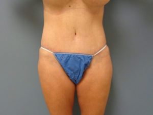 Tummy Tuck Before and After Pictures Nashville, TN