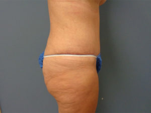 Tummy Tuck Before and After Pictures Nashville, TN