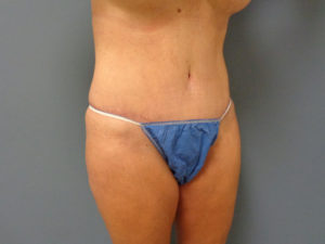 Tummy Tuck Before and After Pictures Nashville, TN