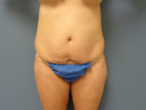 Tummy Tuck Before and After Pictures Nashville, TN