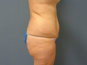 Tummy Tuck Before and After Pictures Nashville, TN