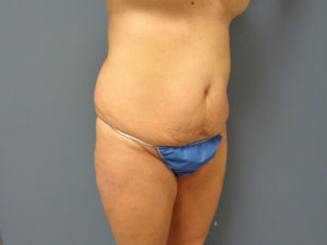 Tummy Tuck Before and After Pictures Nashville, TN