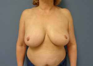 Implant Exchange/Removal Before and After Pictures Nashville, TN